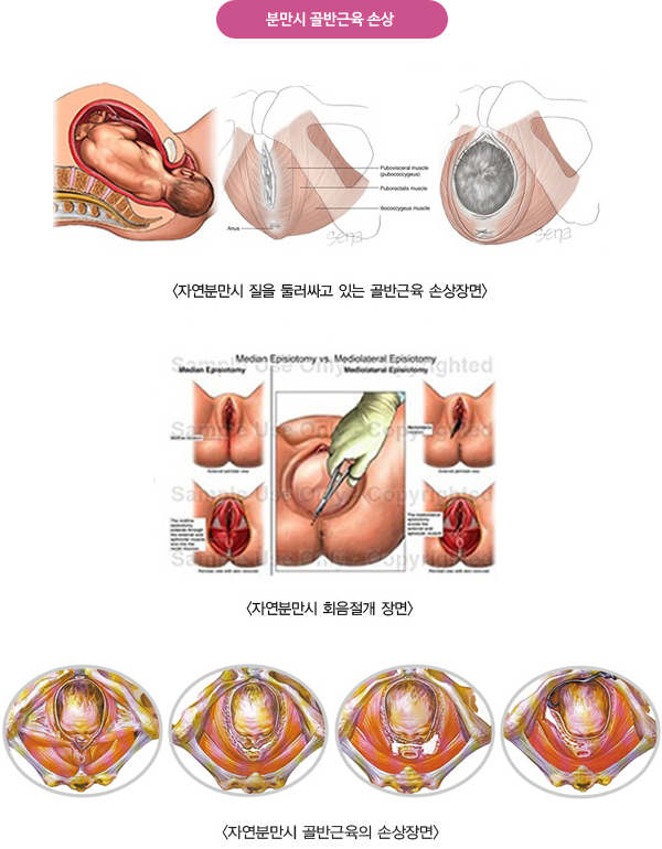 자연분만시 골반근육의 손상장면