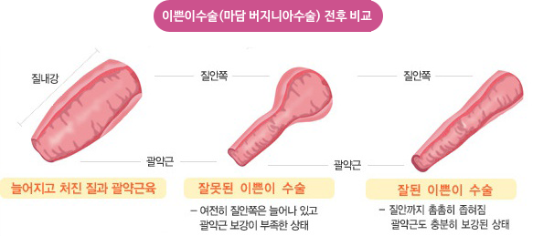 이쁜이수술(마담 버지니아수술) 전후 비교