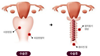 수술전 수술후 비교