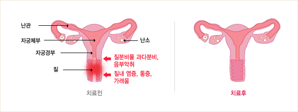 질염 치료전과 치료후의 이미지