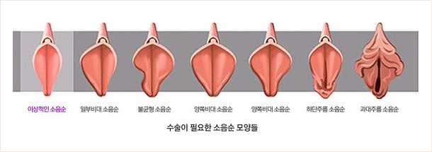 소음순 모형