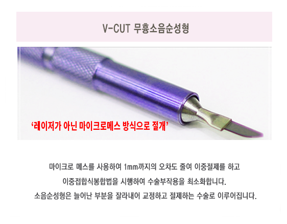 V-CUT 무흉소음순성형