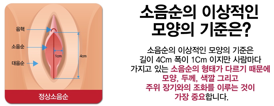 소음순의 이상적인 모양의 기준