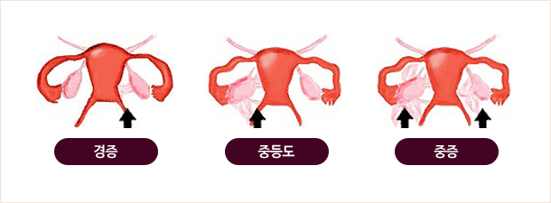 자궁 내막암(경증, 중등도, 중증)이미지