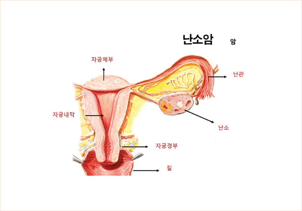 난소암 이미지